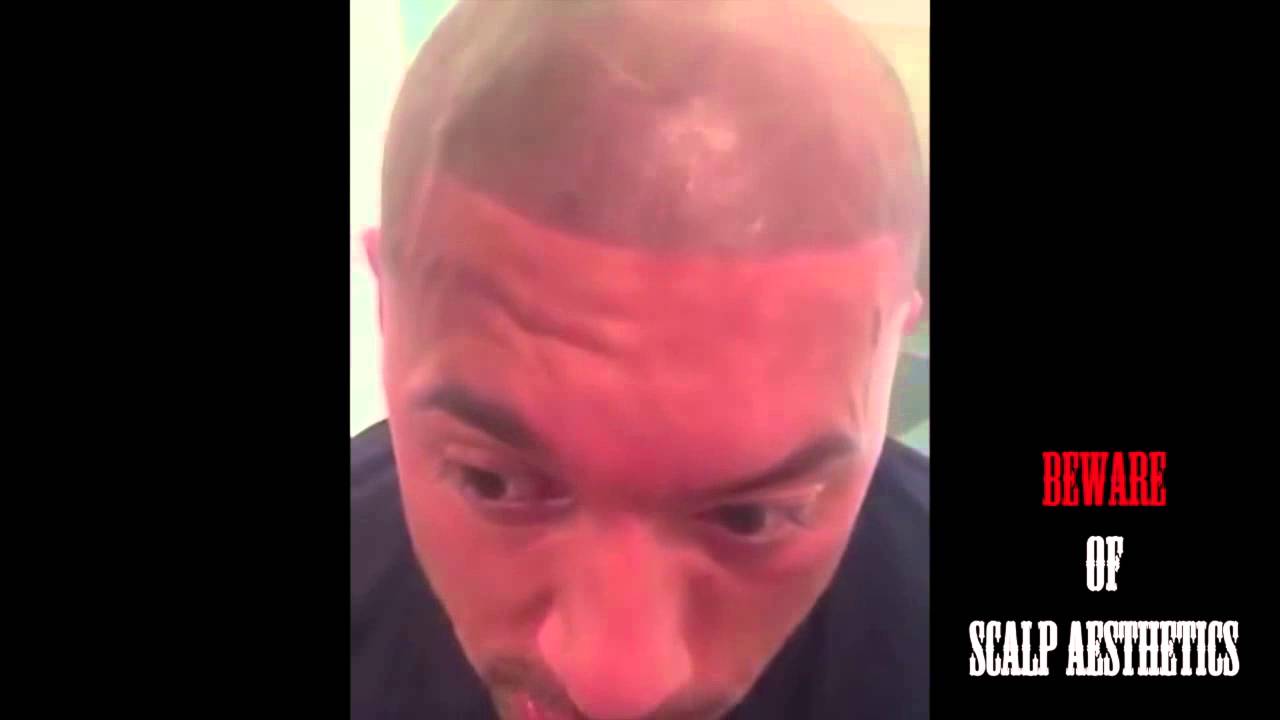 Beware of Scalp Aesthetics-negative review SMP scalp micropigmentation nightmare  part #2