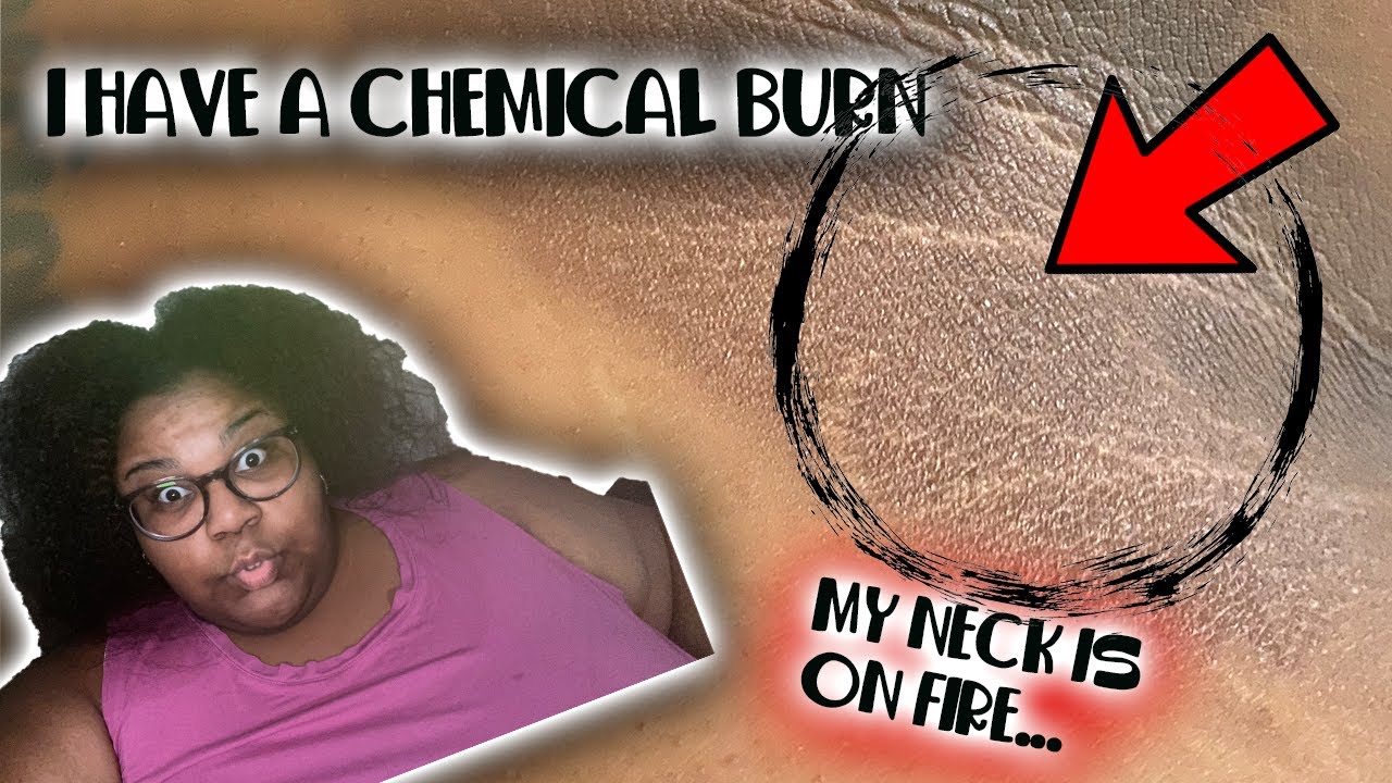 SYNTHETIC HAIR CAUSED AN ALLERGIC REACTION ON MY BODY|  prissy p|  natural hair