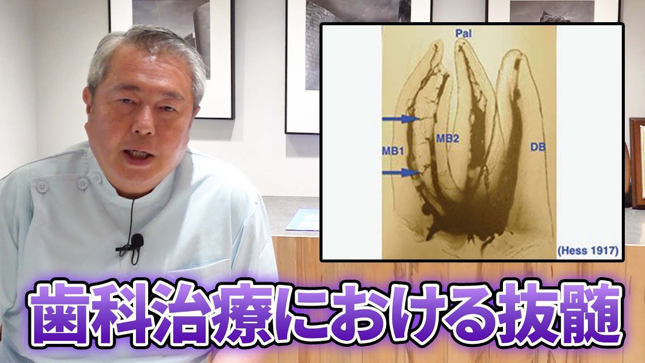 歯の神経を抜く治療ってどんな症状の時に必要？抜歯と抜髄との違いについて解説
