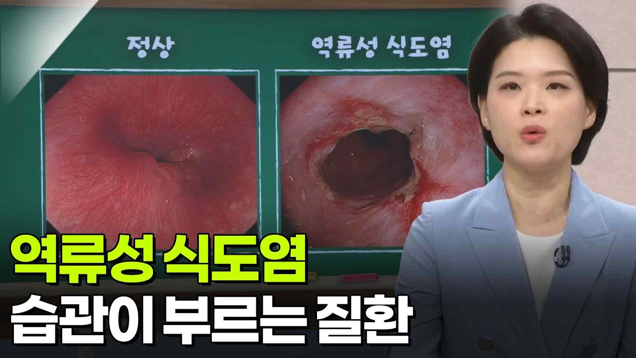 태정현 소화기내과 교수, 습관이 부르는 질환 ‘역류성 식도염’ [아침마당] | KBS 260312 방송