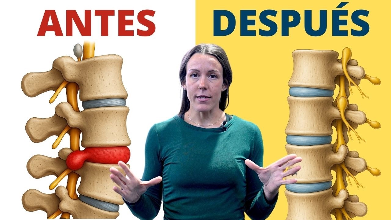 Ejercicios para tratar tu Hernia Discal - ¡Haz esto antes de operarte!