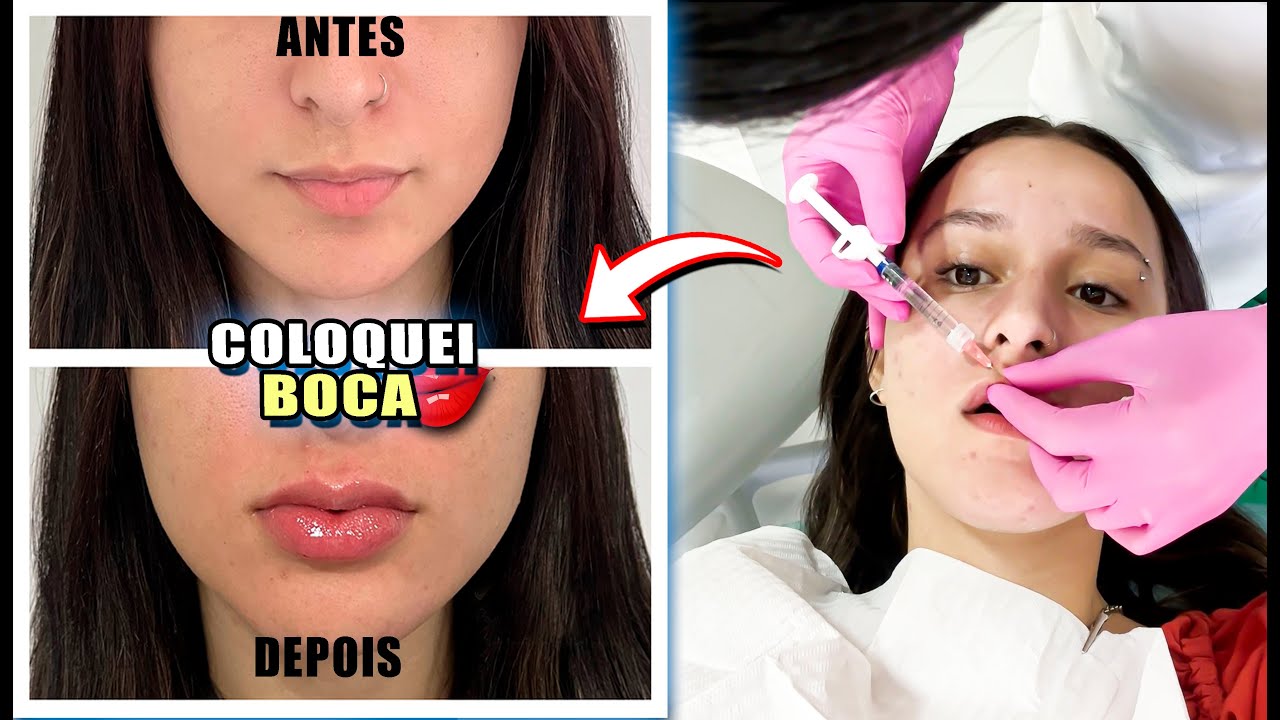 MNHA PRIMEIRA VEZ FAZENDO UM PREENCHIMENTO LABIAL!
