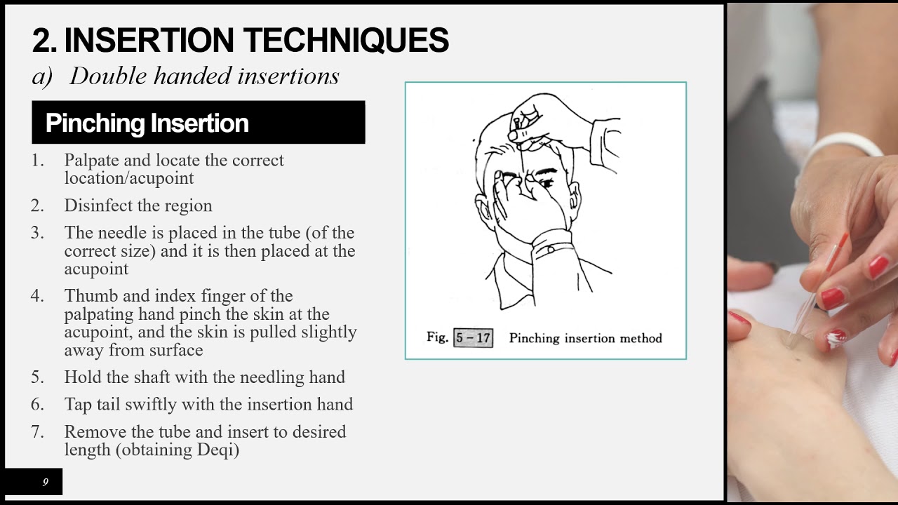 Needling Technique part 1
