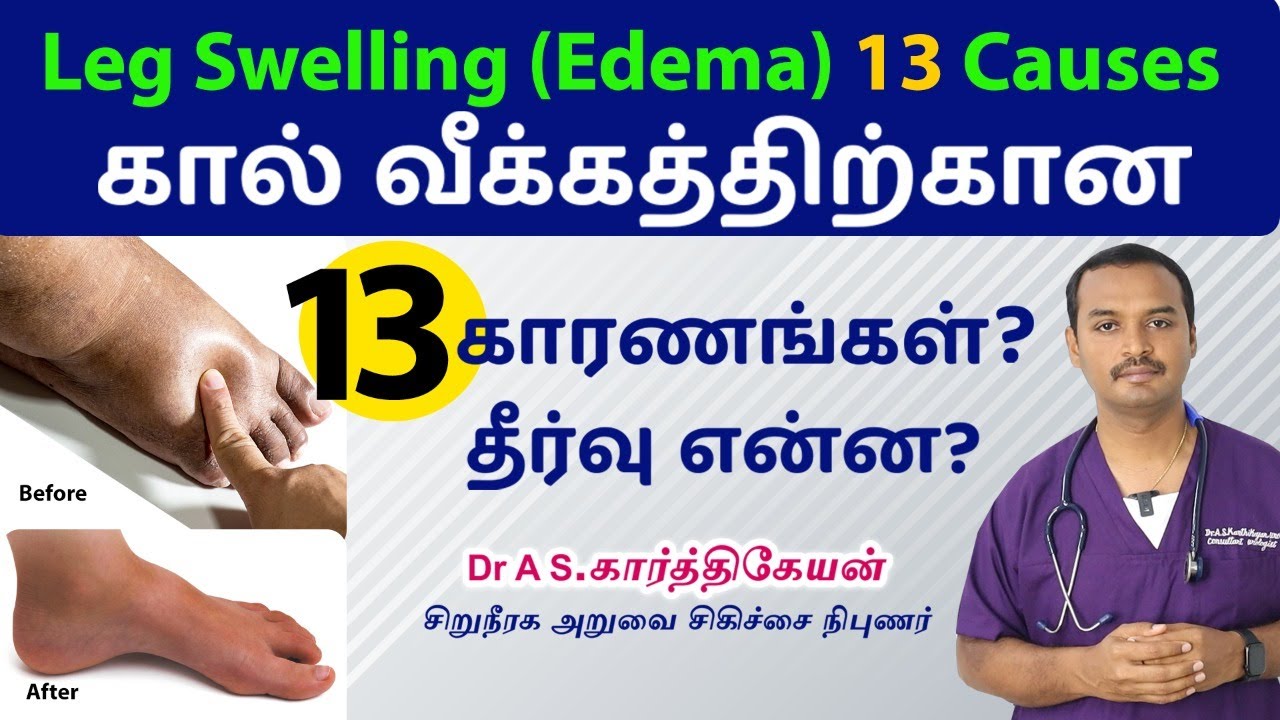 13 causes of  Leg swelling (Edema) | கால் வீக்கத்திற்கான 13 காரணங்கள்? தீர்வு என்ன?