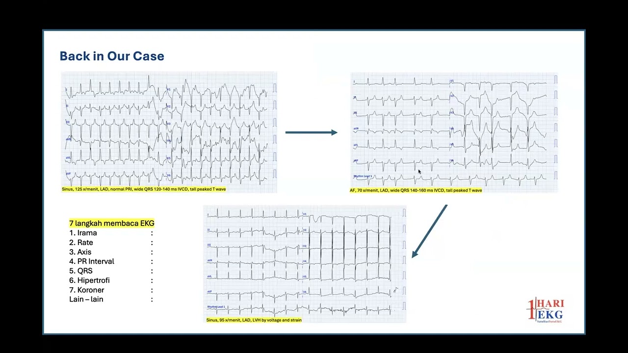 Do Less or More? ECG in Hyperkalemia Patient