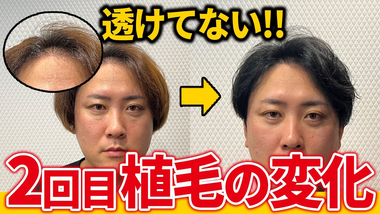 【感激】2回目の植毛から8ヶ月経過した変化が凄すぎる！！