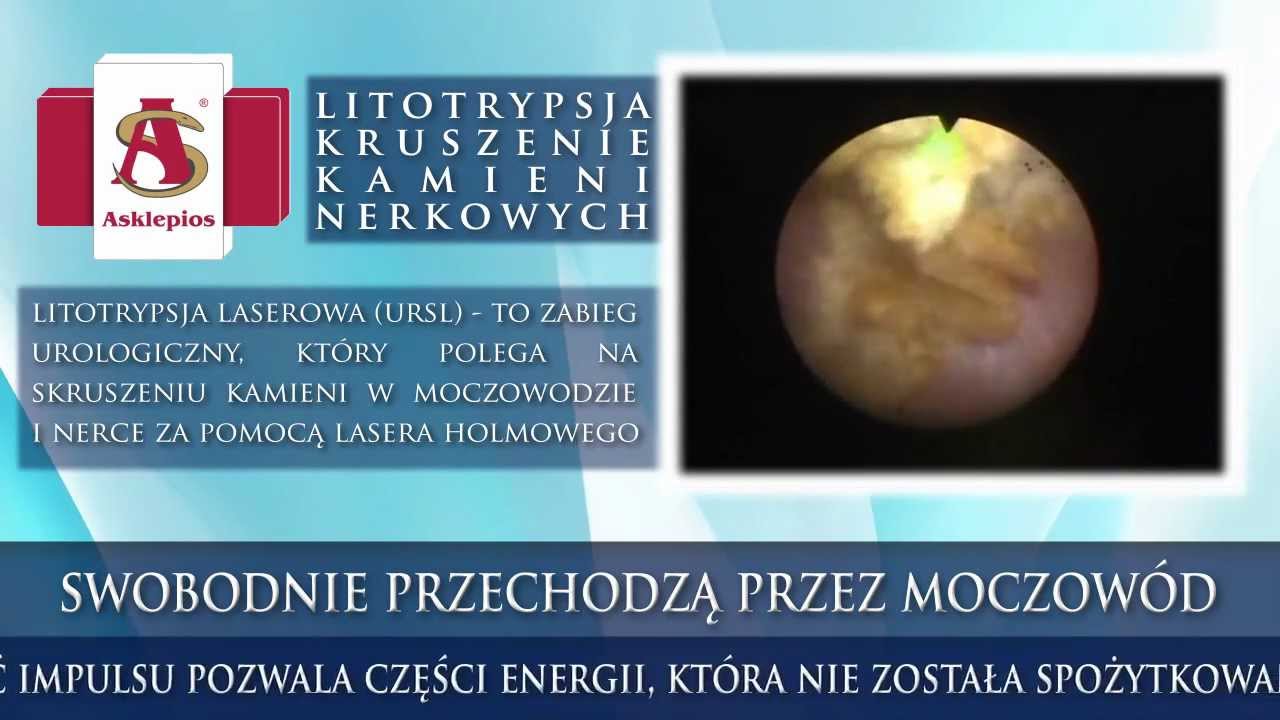 LITOTRYPSJA LASEROWA - KRUSZENIE KAMIENI NERKOWYCH