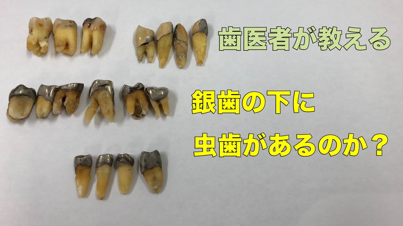 【横浜戸塚　内藤歯科】銀歯の下に虫歯はないの？見てみよう！