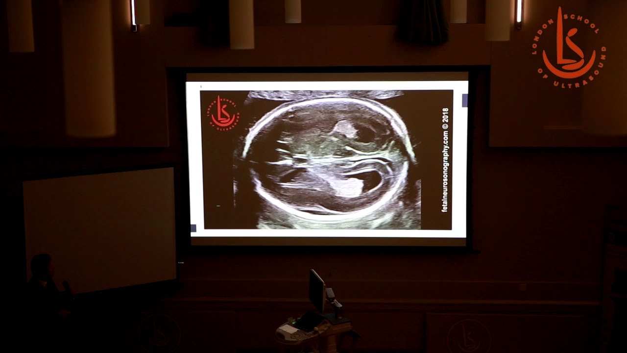 Fetal Neurosonography 2020 by London School of Ultrasound: Video Report