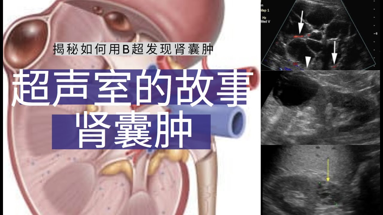 肾囊肿---超声室的故事【Ultrasound Room】Diagnosing Renal Cyst on Ultrasound