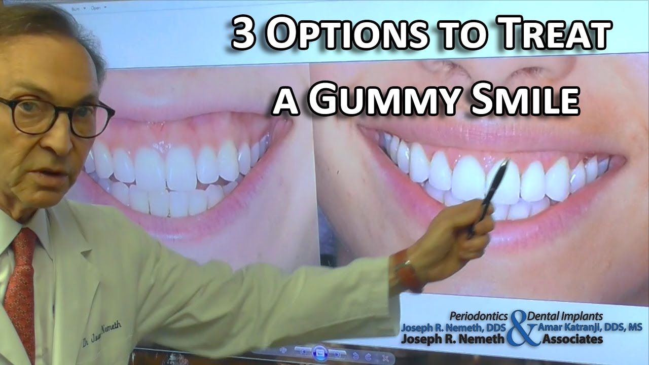 3 Options to Treat a Gummy Smile: Doctors Advice
