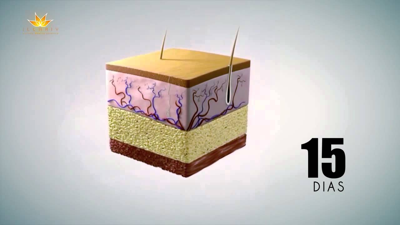Criolipolisis ¿Como Funciona?
