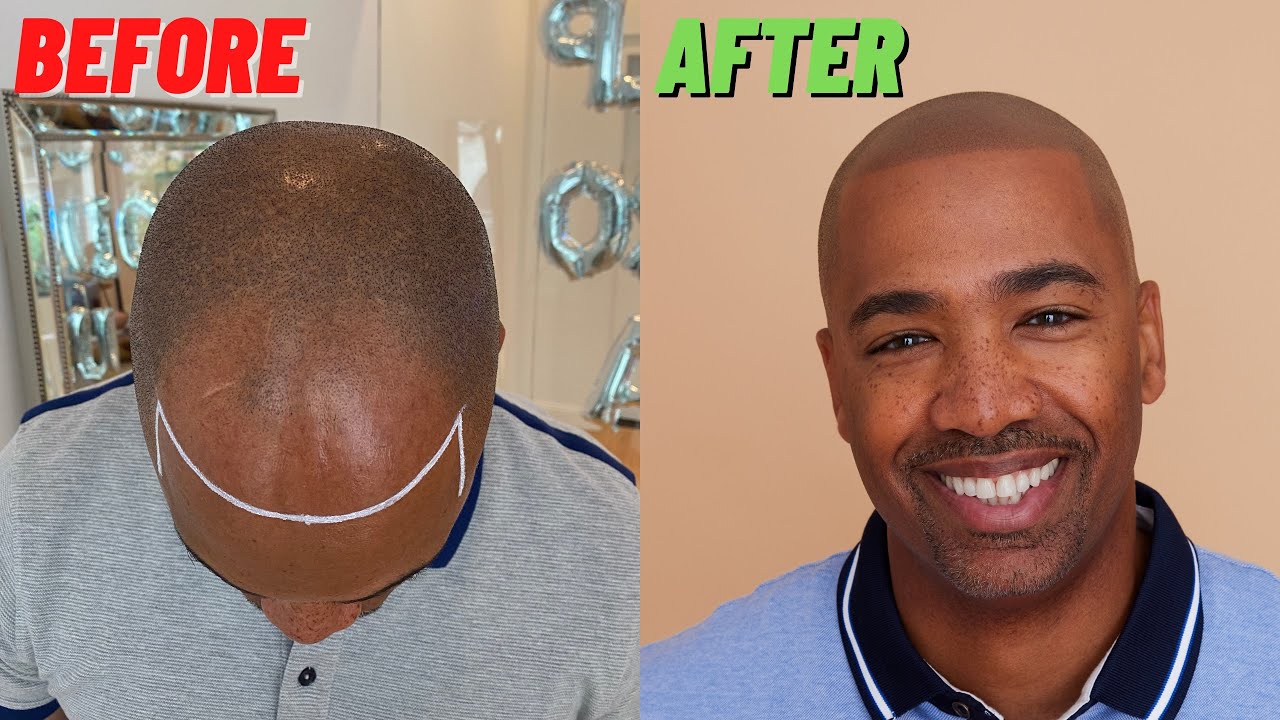 After this, you'll NEVER think twice about SCALP MICROPIGMENTION again