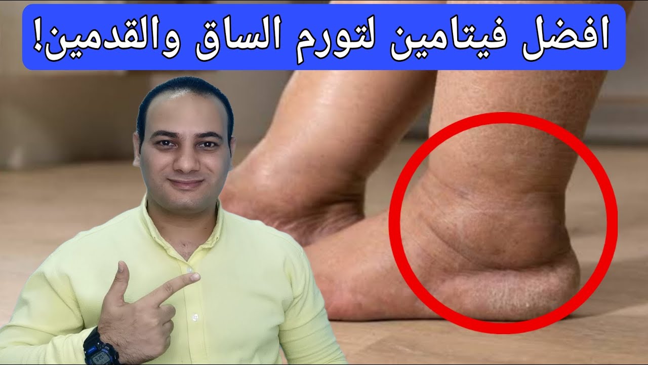 أفضل فيتامين لعلاج تورم القدم والساقين وانتفاخ الرجلين!