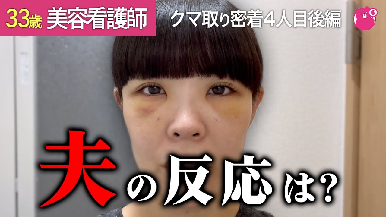 1カ月の裏ハムラダウンタイム実録大公開！夫の反対を押し切った目の下のクマ取り整形！やって良かった！！【クマ取り密着4人目後編】【美容整形】