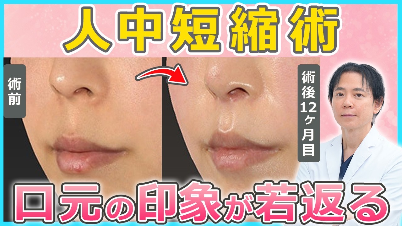 人中短縮術で口元が若返る！症例写真とともに施術方法や適応を徹底解説