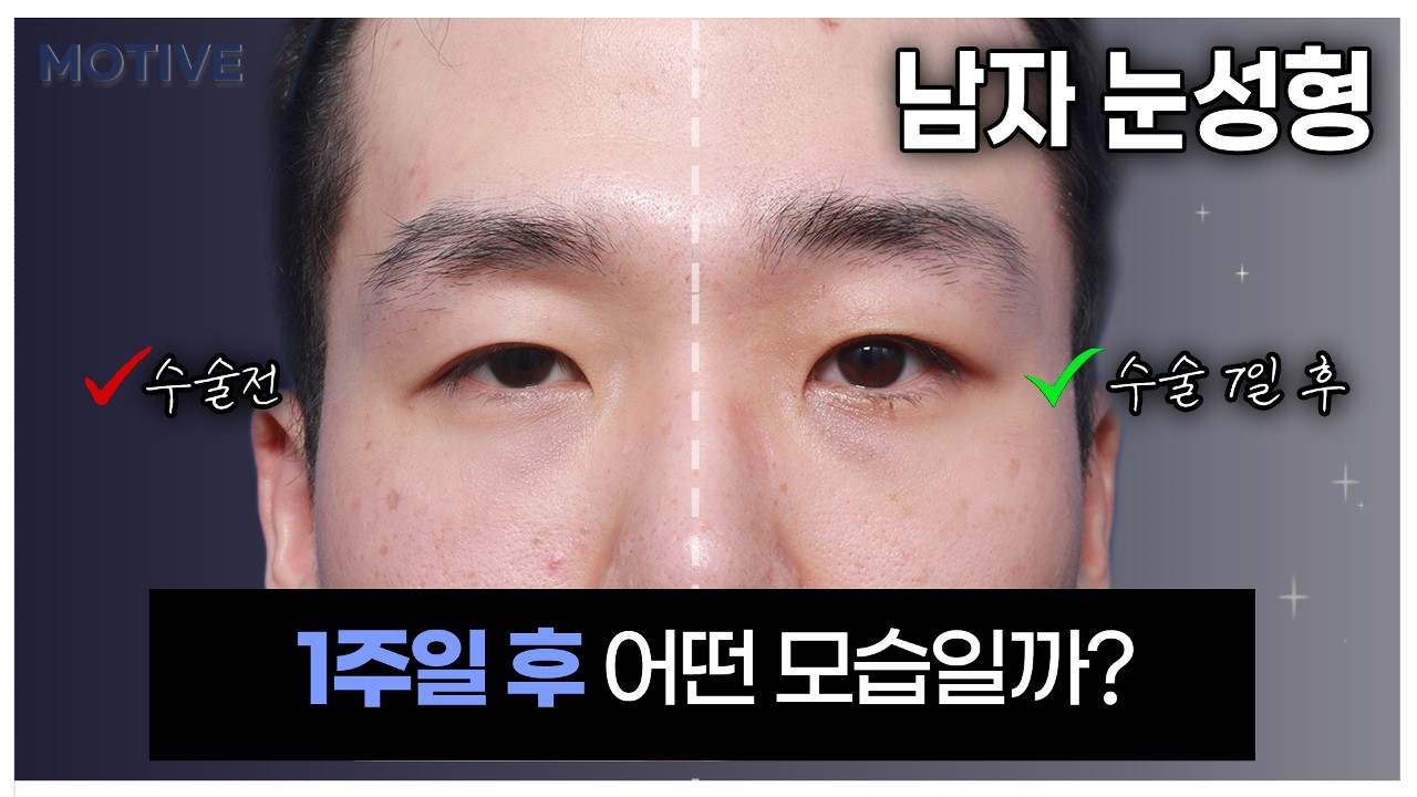남자 눈성형 1주일 후 어떤 모습일까 솔직히 공개합니다!