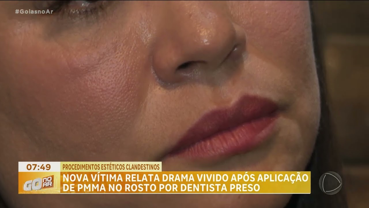 PROCEDIMENTOS ESTÉTICOS CLANDESTINOS: NOVA VÍTIMA RELATA DRAMA VIVIDO APÓS APLICAÇÃO DE PMMA