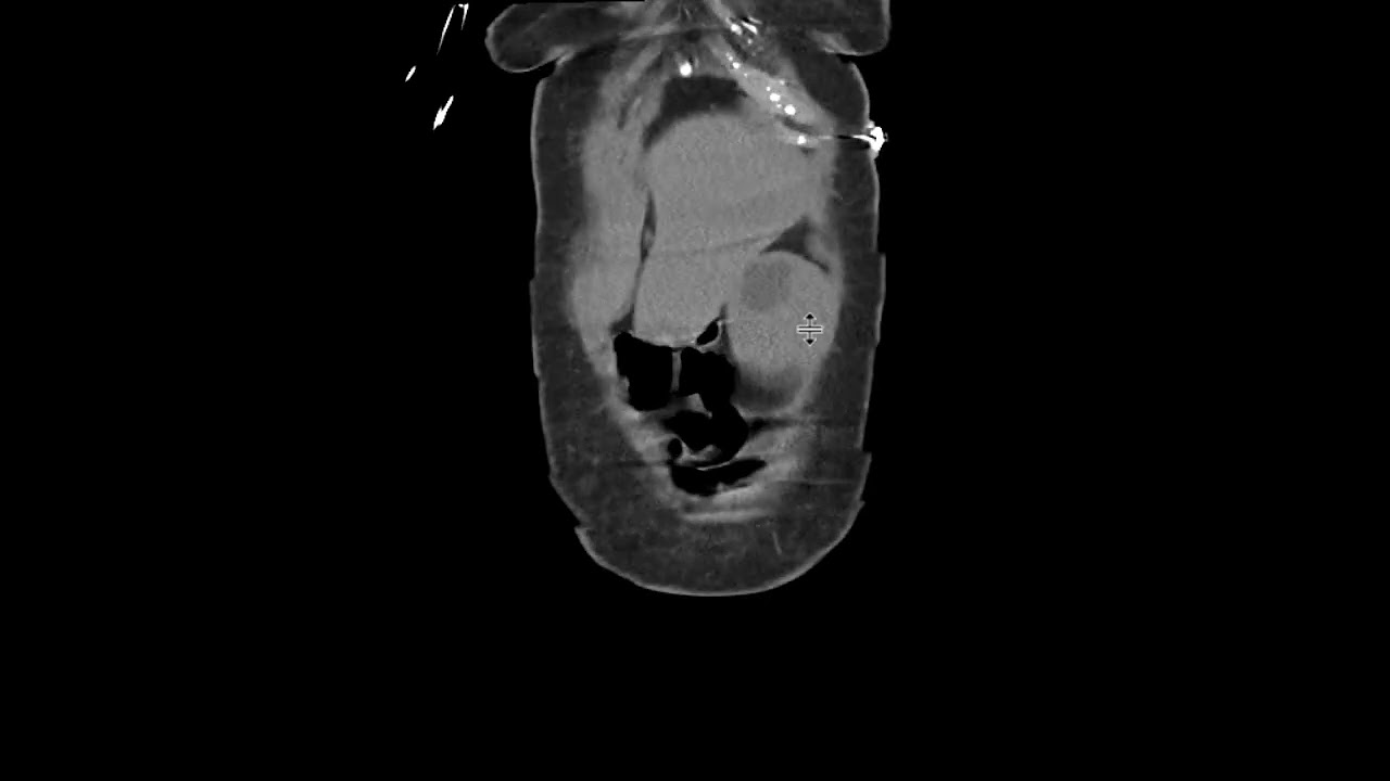 Myelofibrosis