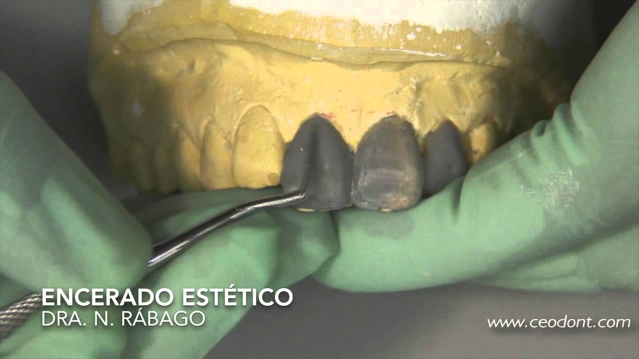 Ceodont: Curso de Estética Dental: Encerado estético + Mock up