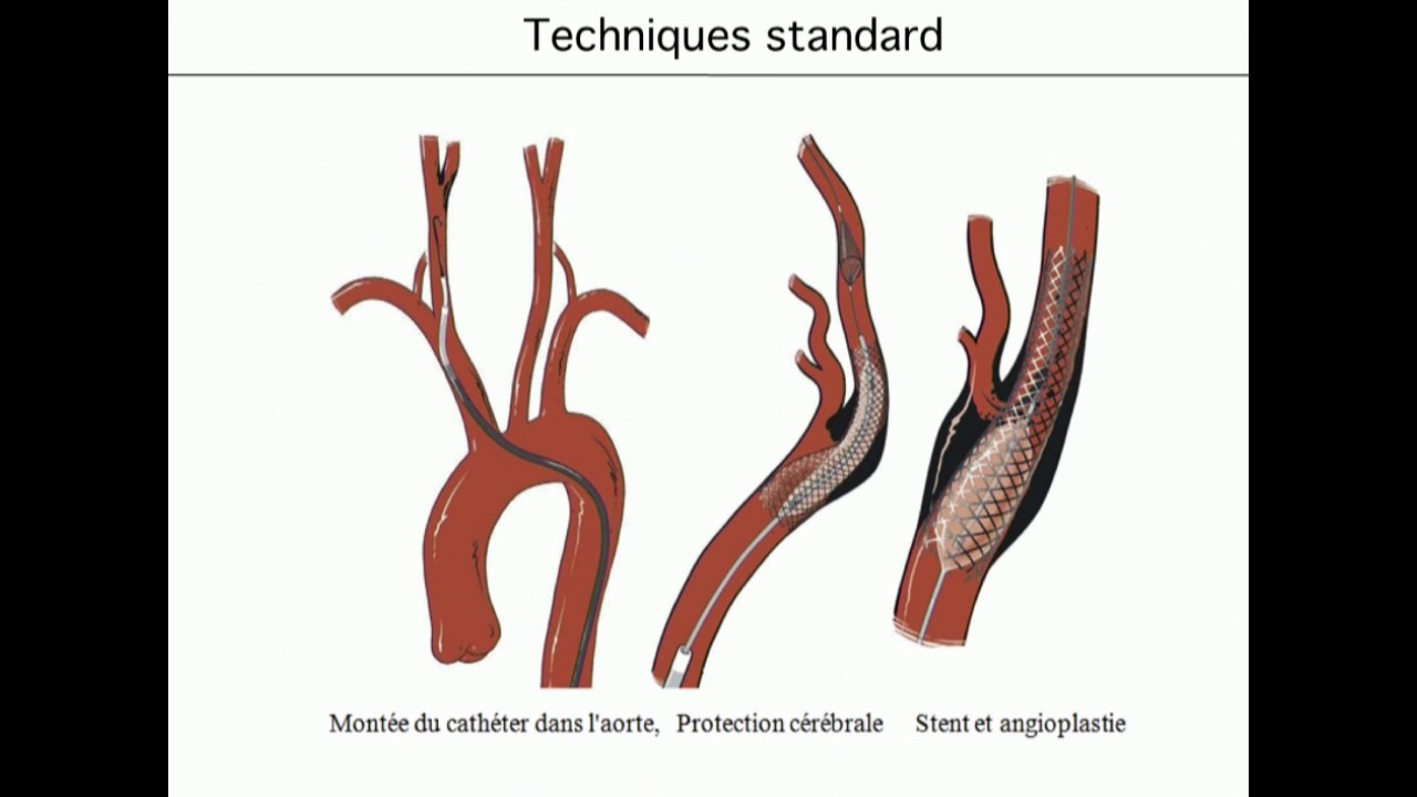 Aspects techniques des angioplasties carotidiennes
