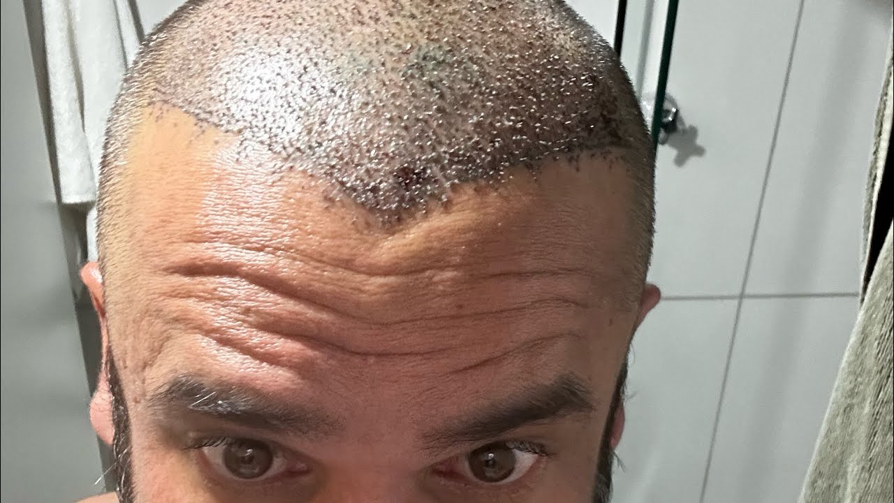 Quanto paguei em meu transplante capilar R$?????