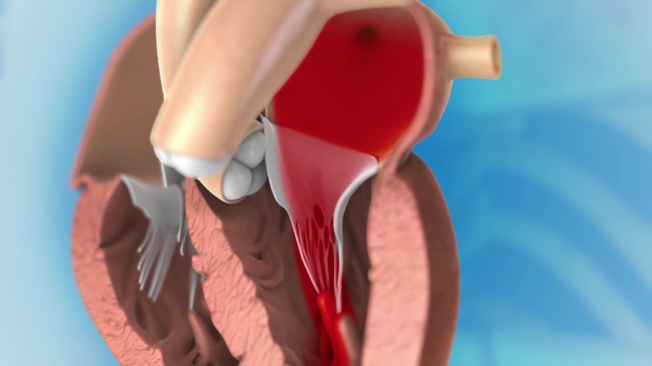Die Rekonstruktion der Mitralklappe