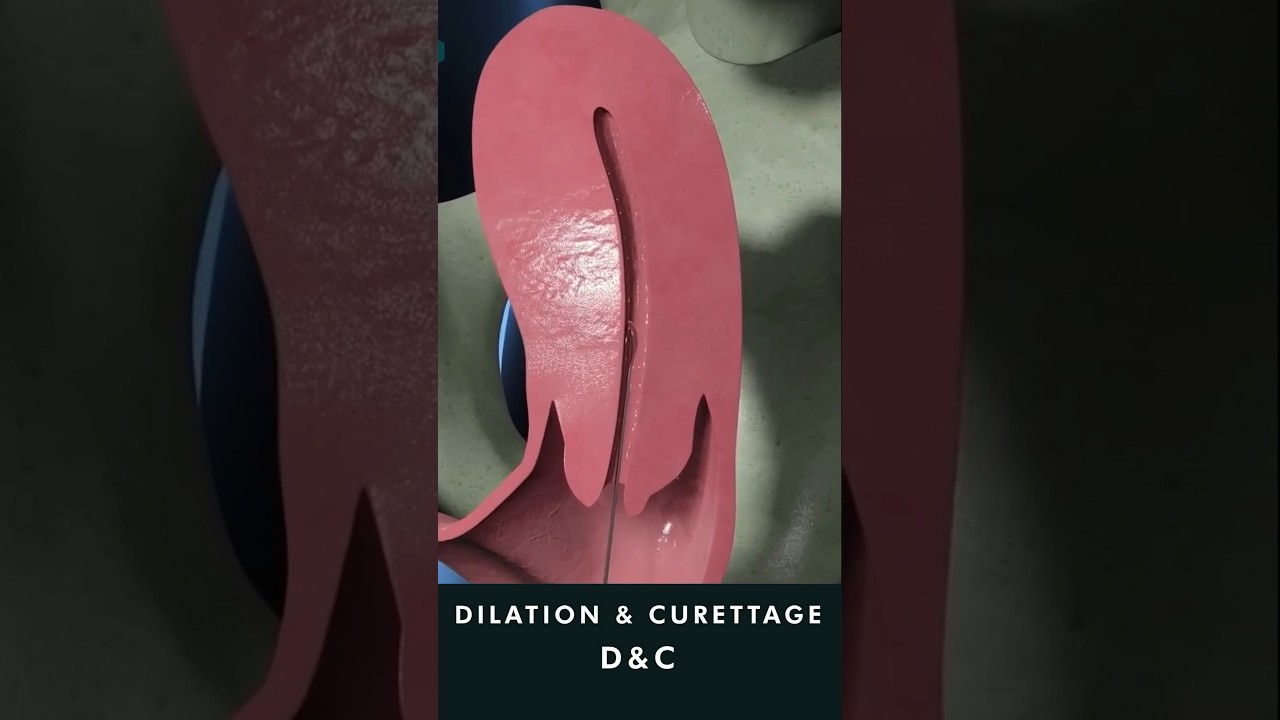 Dilation and Curettage D&C animation #uterinecancer #treatment
