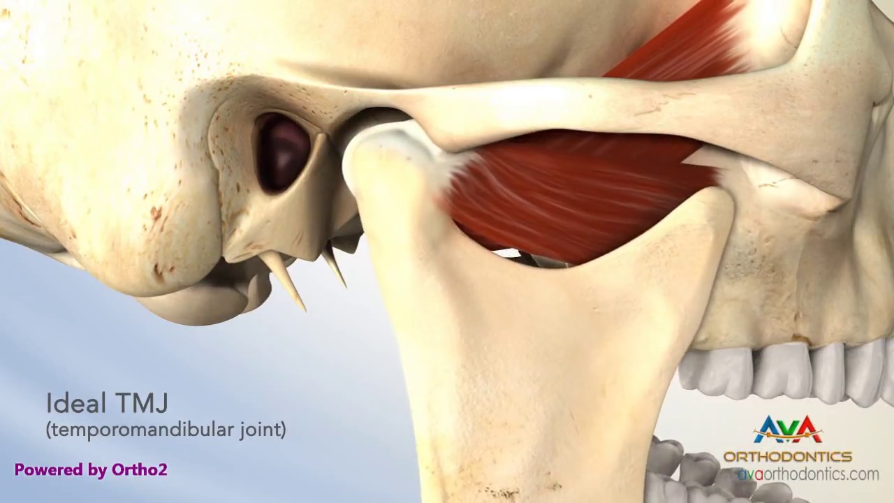 TMJ Disorder or TMD - Clicking and Closed Lock