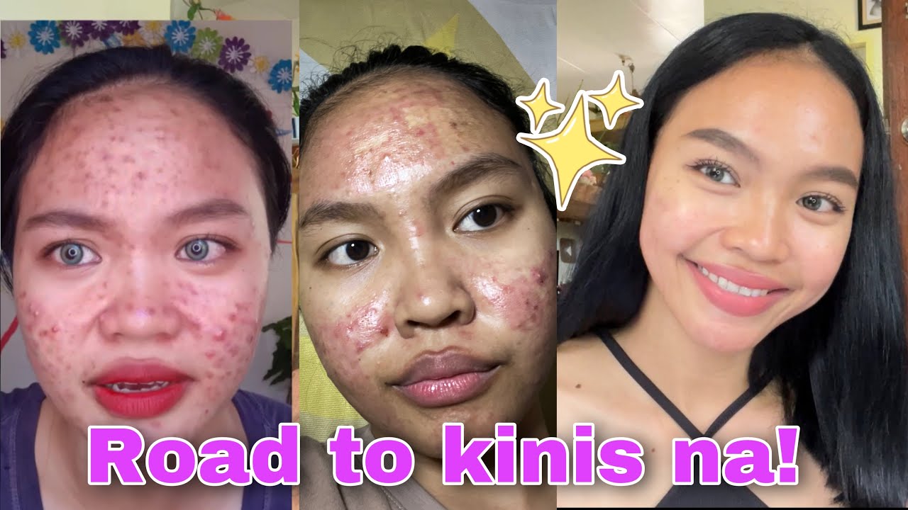 ROAD TO KINIS NA! PAANO NAWALA PIMPLES KO?! 😱