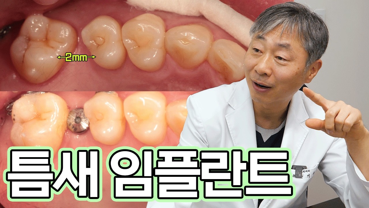 🙅‍♂️치아 안 깎았음🙅‍♂️ 2mm의 좁은 공간에 임플란트를 쏘옥 심어드렸습니다!