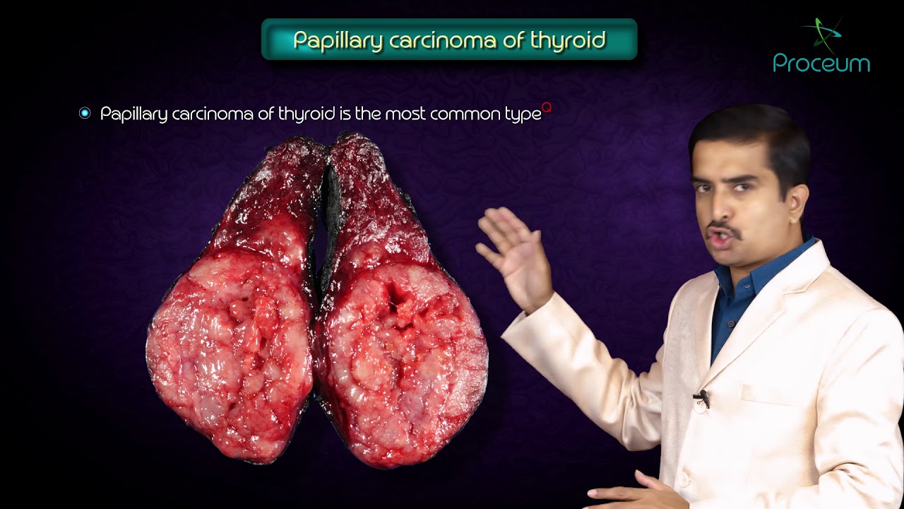 Thyroid neoplasms part 1 ( Papillary carcinoma of thyroid ) - Endocrine pathology