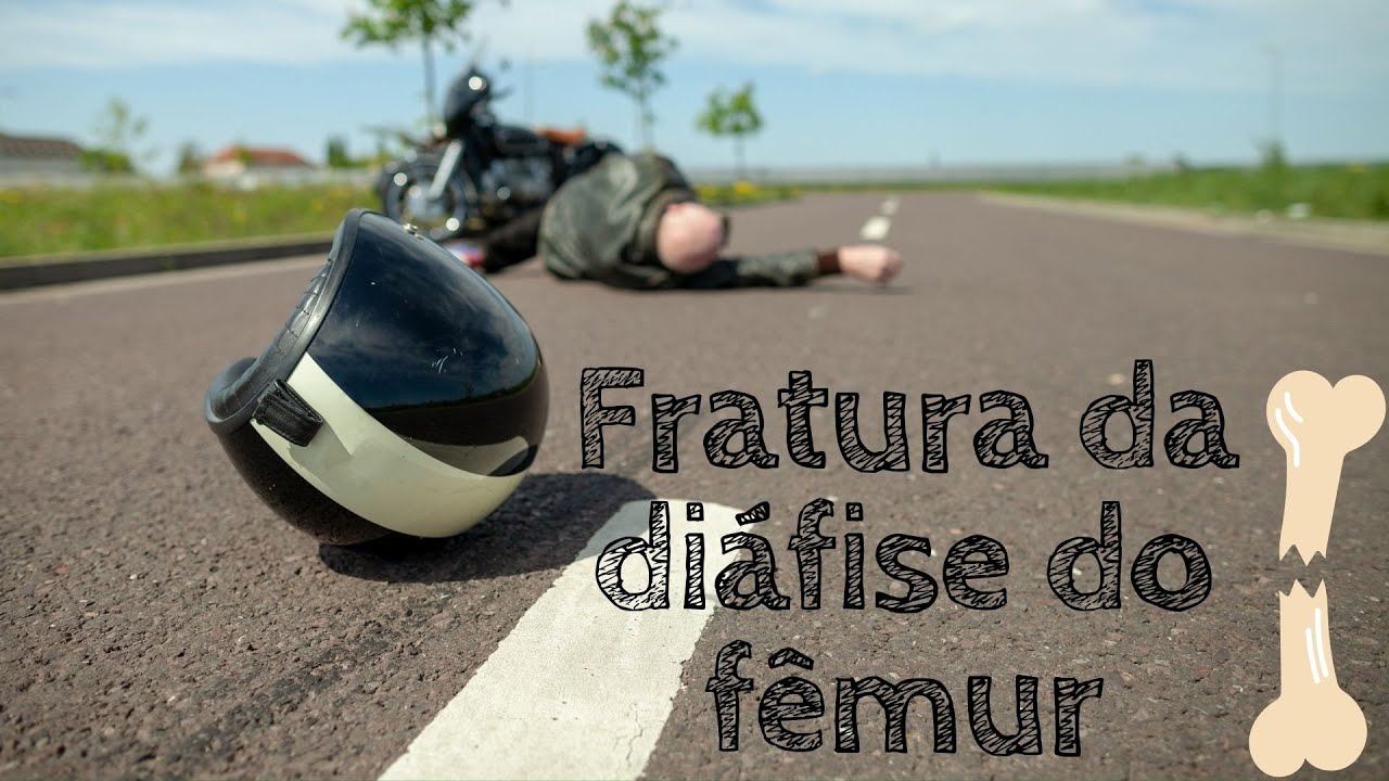 Fratura de fêmur -  Reabilitação