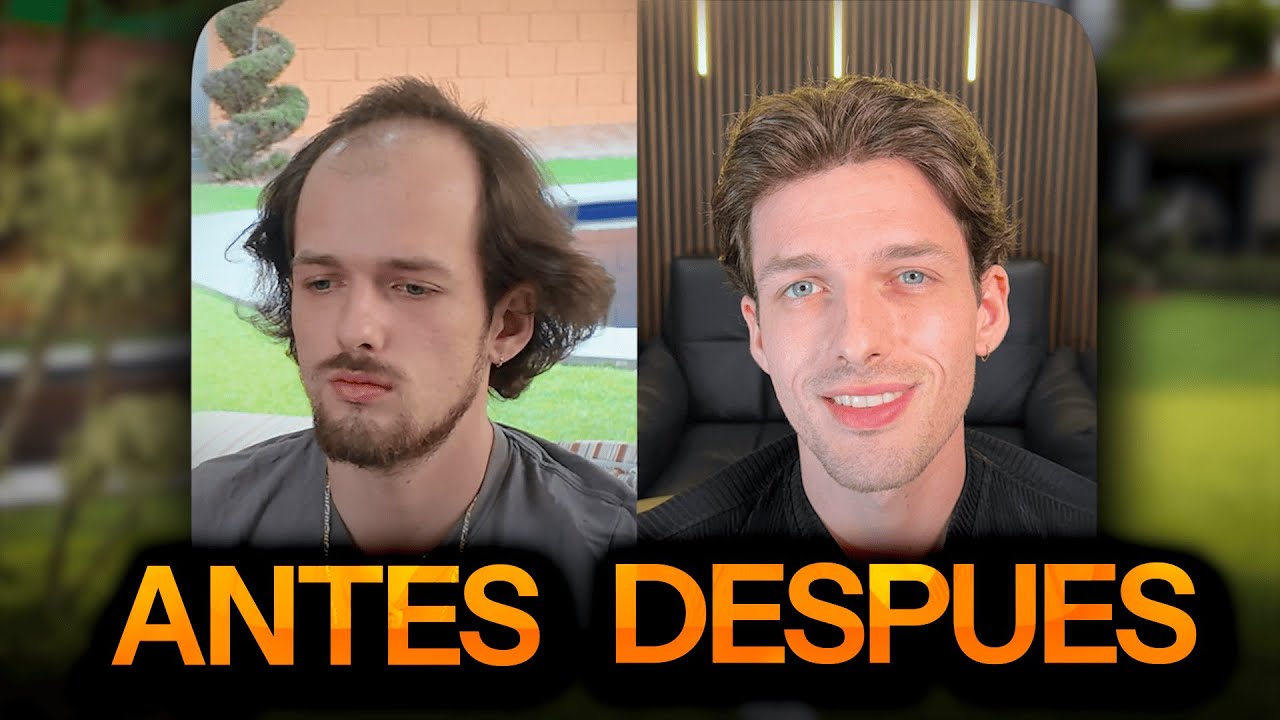 Instalamos una prótesis capilar en Cuernavaca 😱 | El cambio de Juanpa en 1 día