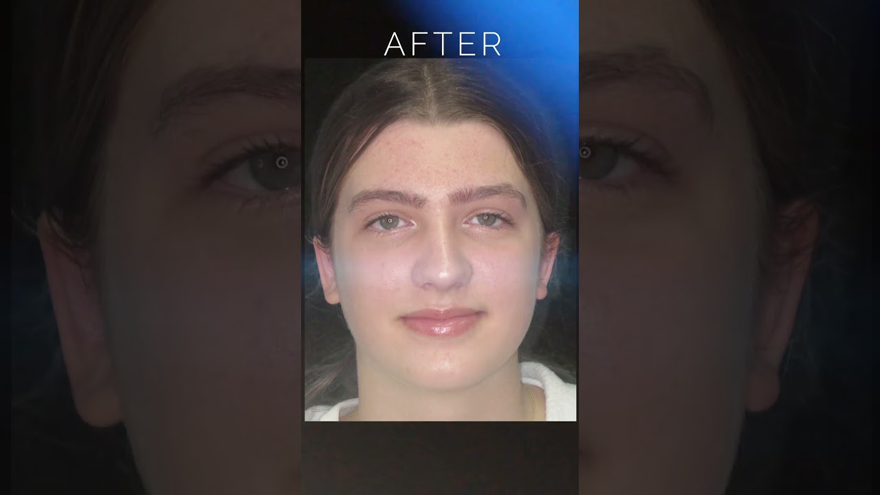 Otoplasty (Ear Pinning Surgery) Results: Before & After Pictures 