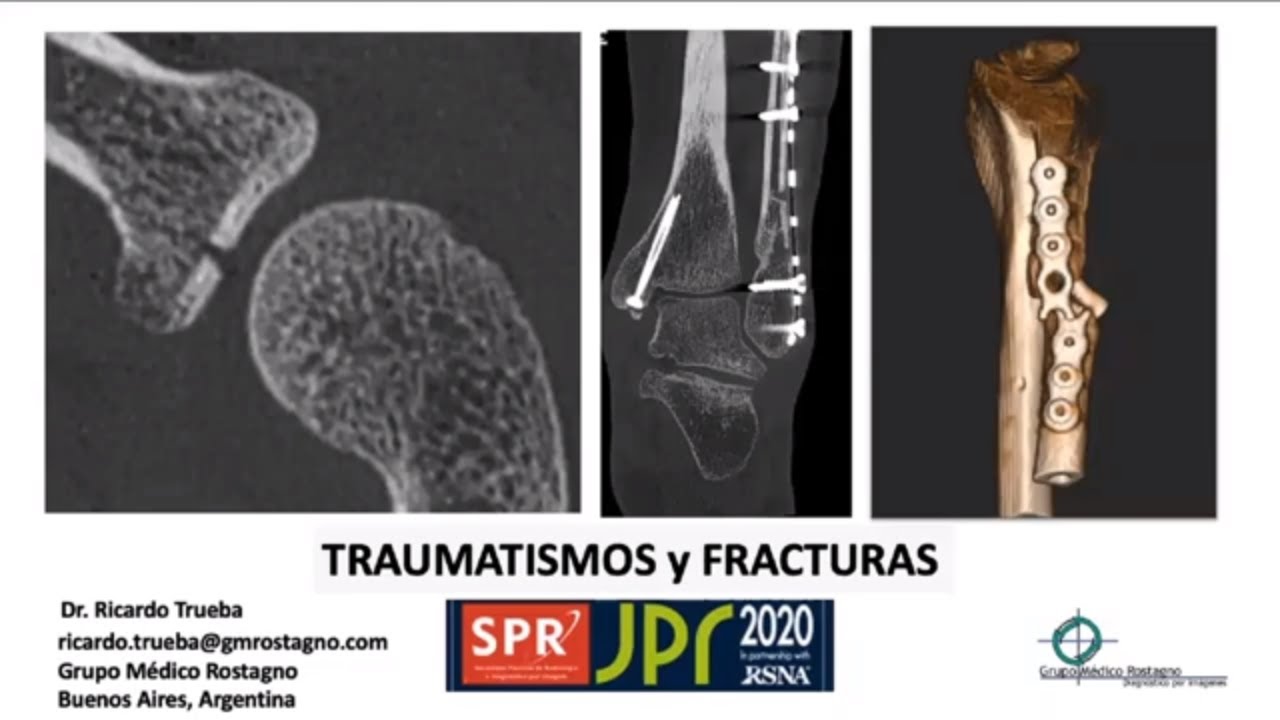 Traumatismos y fracturas con Tomografía Cone Beam (CBCT) siguiendo la clasificación de la AO