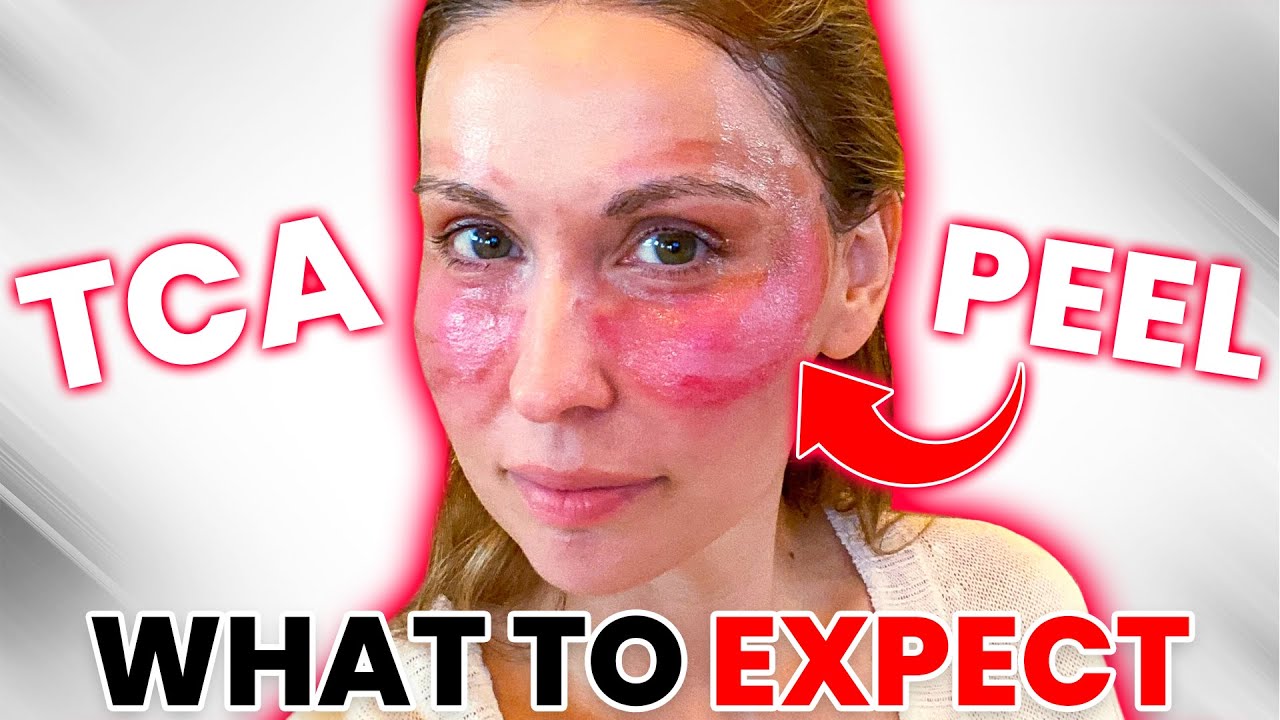 TCA Peel for the Eyes - My Day by Day Recovery