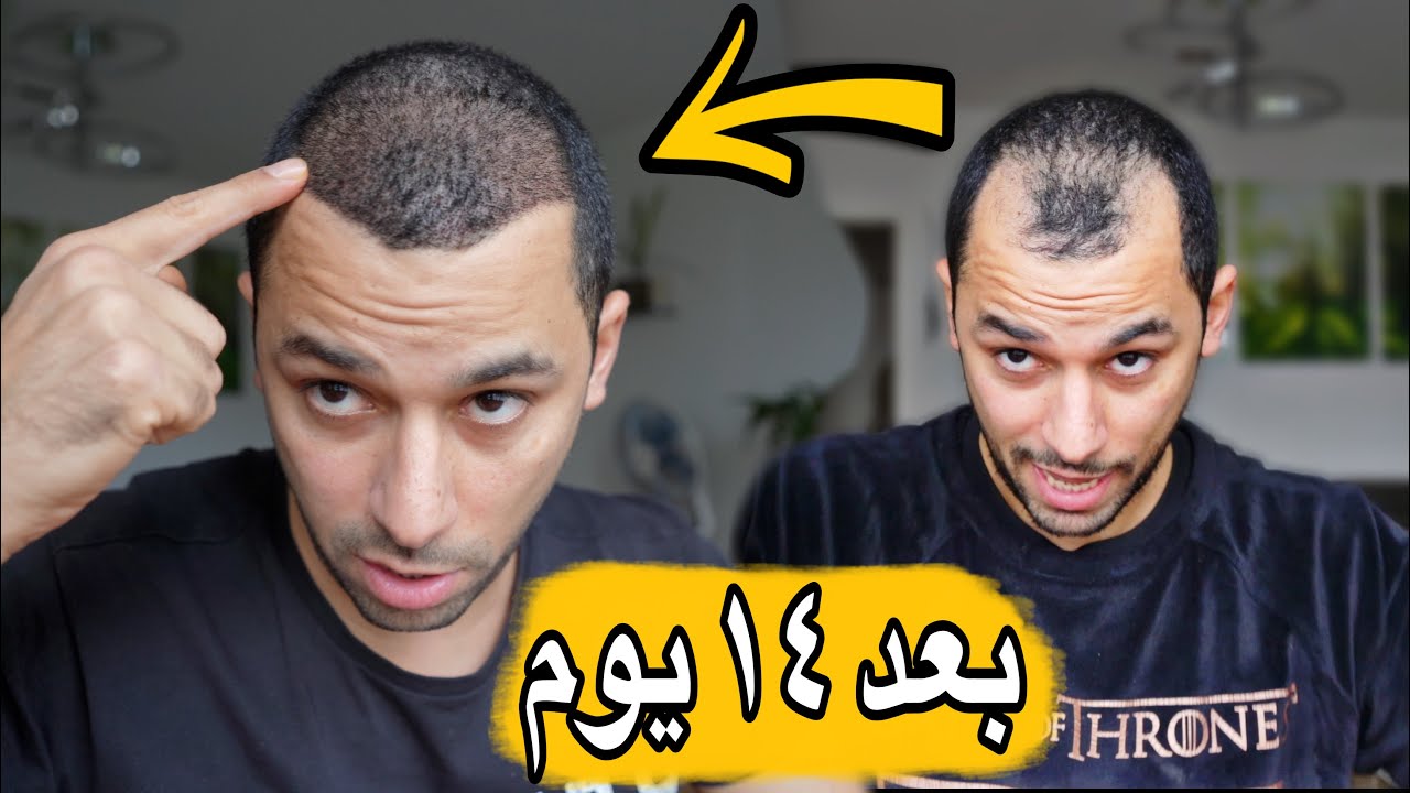 HOW MUCH $ دفعت كام في زراعة شعري في تركيا