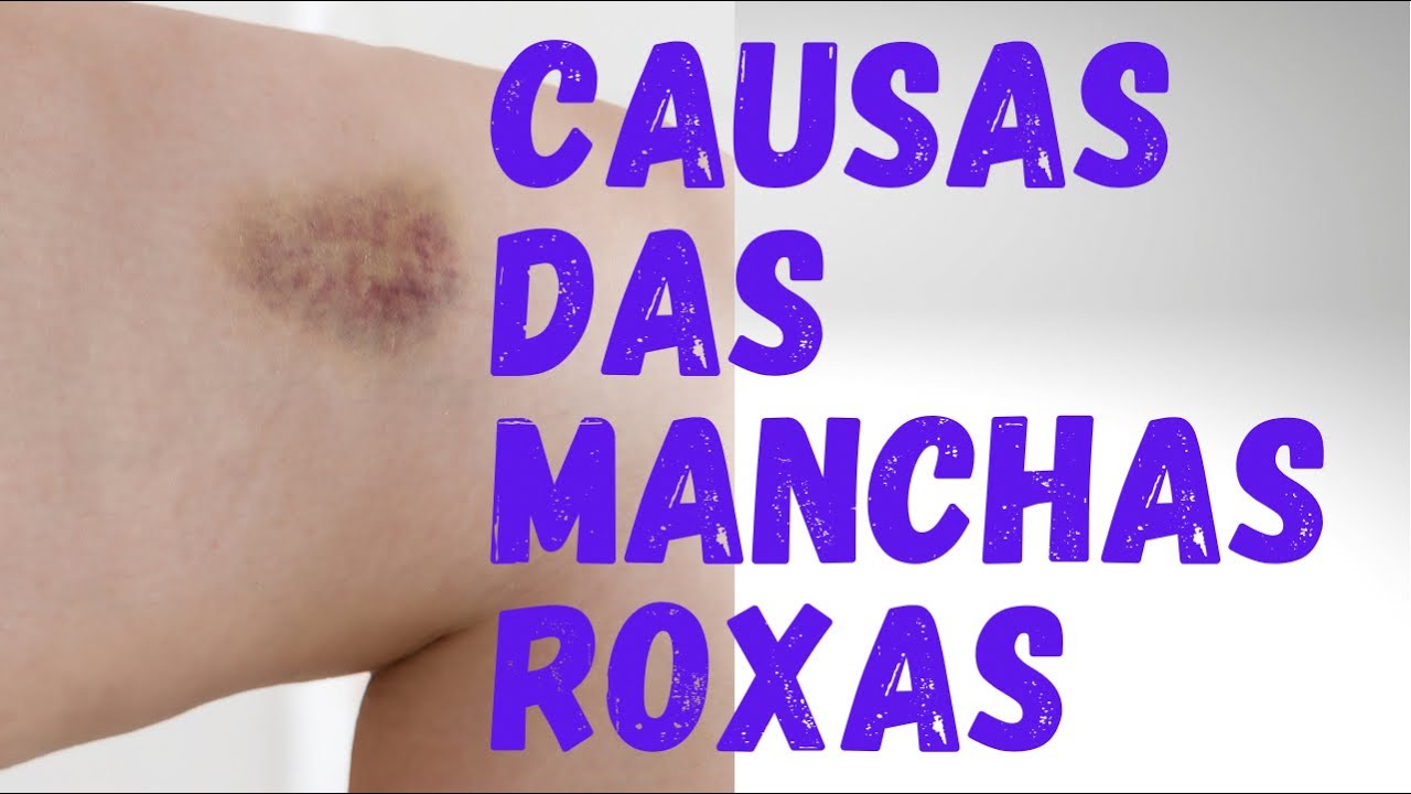 Causas das manchas roxas na pele #manchasroxasnapele #hematomas  #sangramento