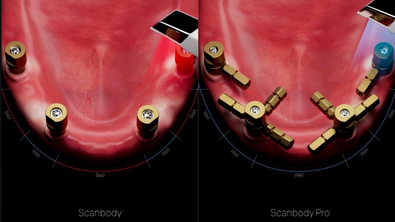 Scanbody pro by Dentis