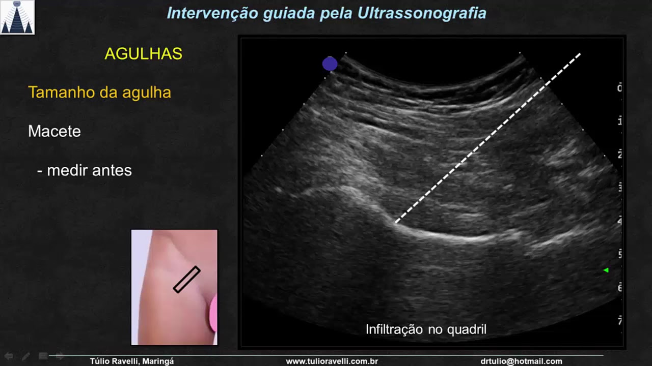 Curso de Intervenção guiada pela Ultrassonografia nos Membros Superiores,