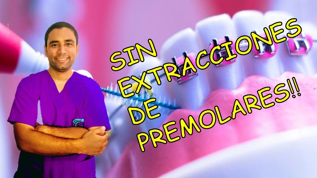 Te explico super bien!!como crean los espacios en Ortodoncia Evitando al máximo sacar premolares? 😎👌