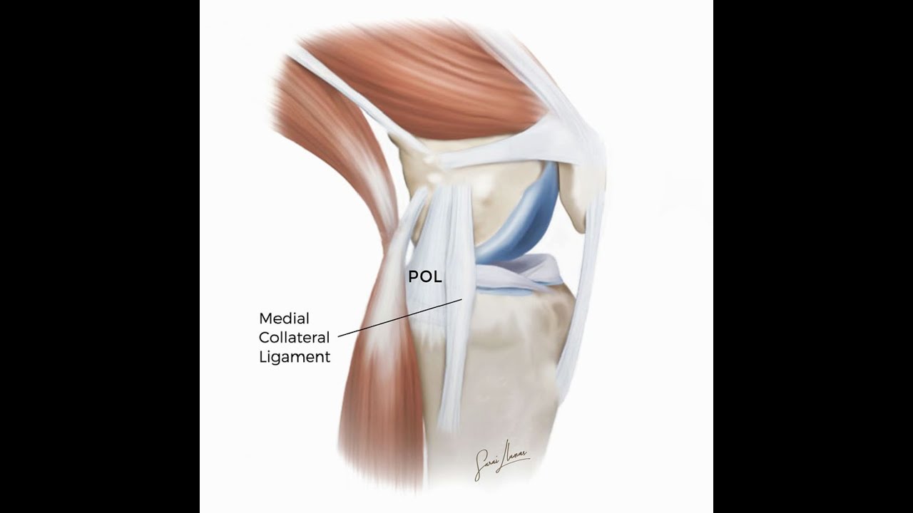 Episode 85: Collateral Damage: Acute Knee Injuries