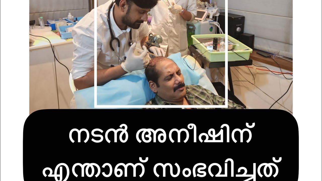 നടൻ അനീഷിന് സംഭവിച്ചത് | Aneesh Ravi  Hair transplantation  #dlapp #hairtransplantation #hairloss