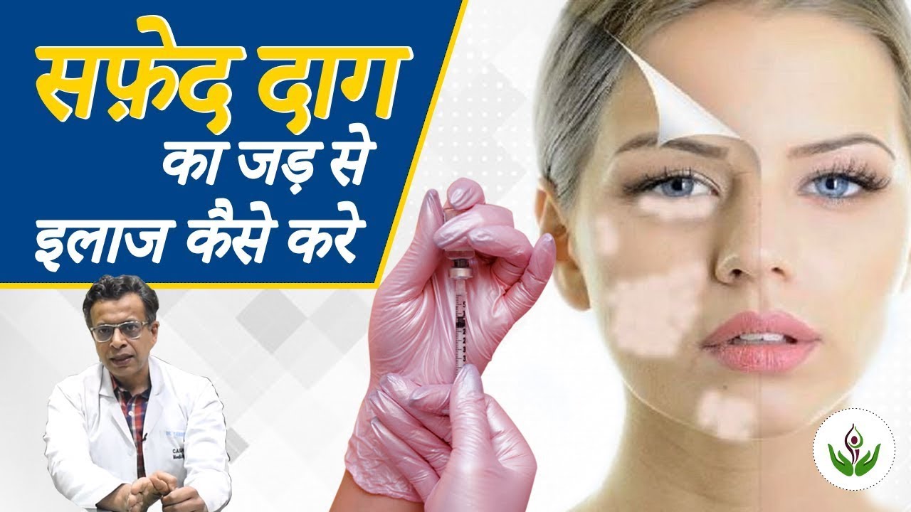सफेद दाग का जड़ से इलाज करे | Treat White Spot 