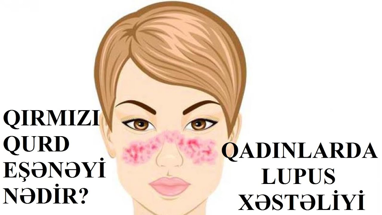 Qırmızı qurd eşənəyi nədir? Qadınlarda Lupus xəstəliyi