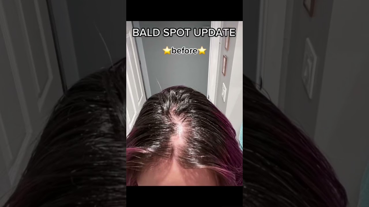 Bald spot regrowth update #femalehairloss #hairregrowthjourney