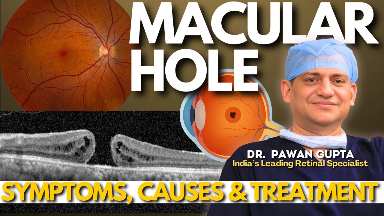Macular Hole: Symptoms, Causes & Treatments | Dr. Pawan Gupta