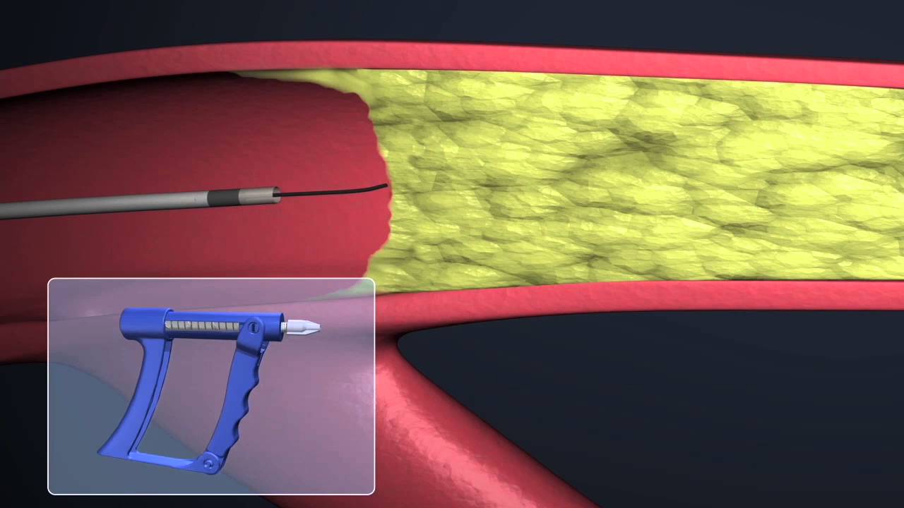 SPINR&trade; High-Performance Guidewire Controller