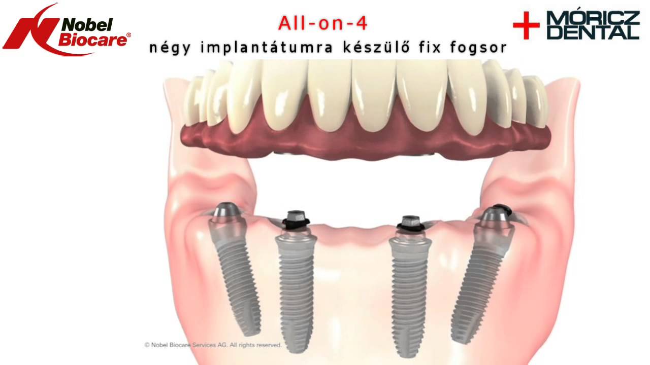 All-on-4 n&eacute;gy implant&aacute;tumra &eacute;p&uuml;lő fixen r&ouml;gz&iacute;tett fogsor a M&oacute;ricz Dentalban